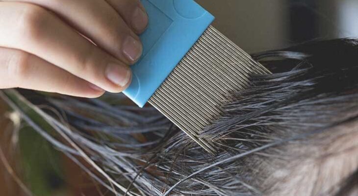 Sorts, Causes, Analysis and Therapy of Head Lice