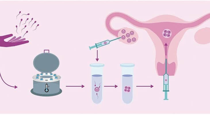 The Benefits of Delayed Frozen Embryo Transfer  