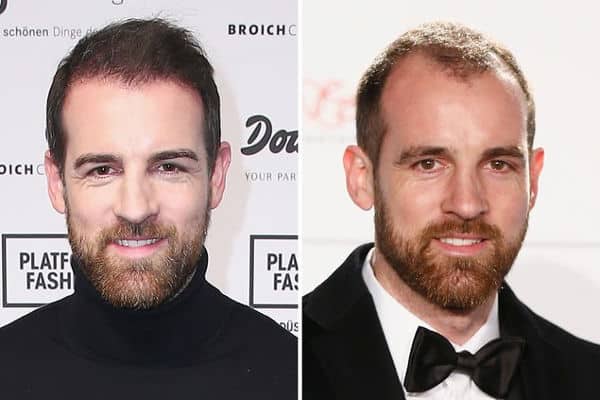 Hair Transplant Singapore: How Painful is a Hair Transplant?