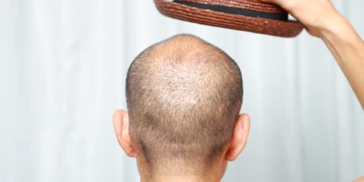 Is it true that sporting hats could make you bald?