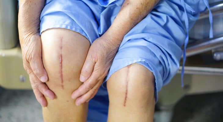 Why Ought to You Contemplate Knee Alternative Surgical procedure?
